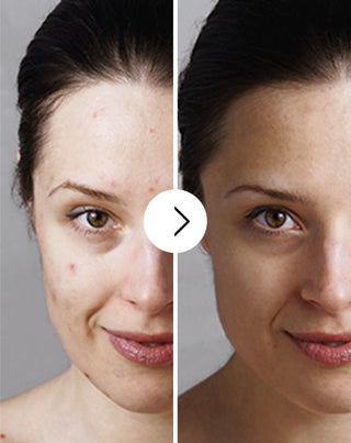 Derminax tabletės nuo spuogų, inkštirų ir netobulumų su cinku, vitaminu C, E ir B2_3 - 3