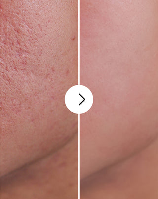 Derminax tabletės nuo spuogų, inkštirų ir netobulumų su cinku, vitaminu C, E ir B2_4 - 4