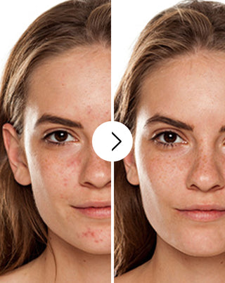 Derminax tabletės nuo spuogų, inkštirų ir netobulumų su cinku, vitaminu C, E ir B2_2